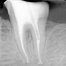 endodonzia